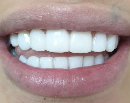 Μέθοδος Bonding