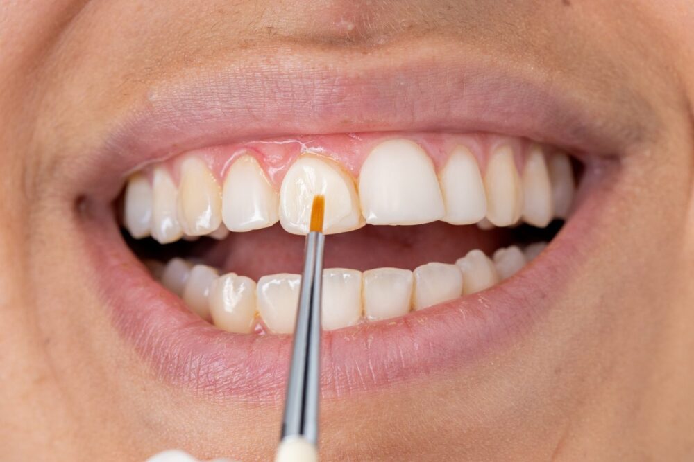 Σύνθετο Bonding